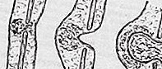 Umbilical hernia in children Physiological umbilical hernia of the fetus 10 weeks